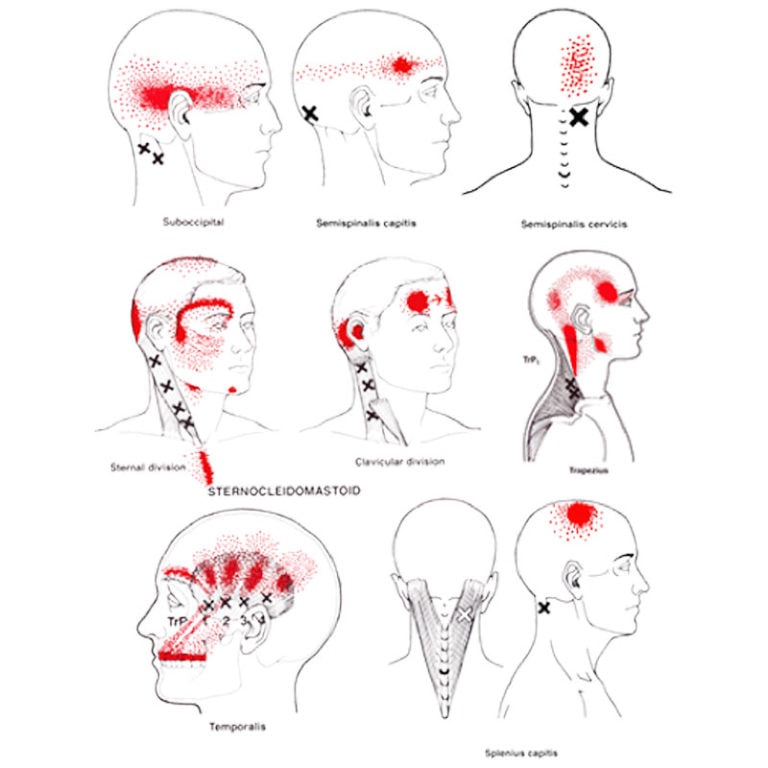 image showing trigger point referral patterns involved in tension headaches